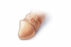 contraindications for penis enlargement soda